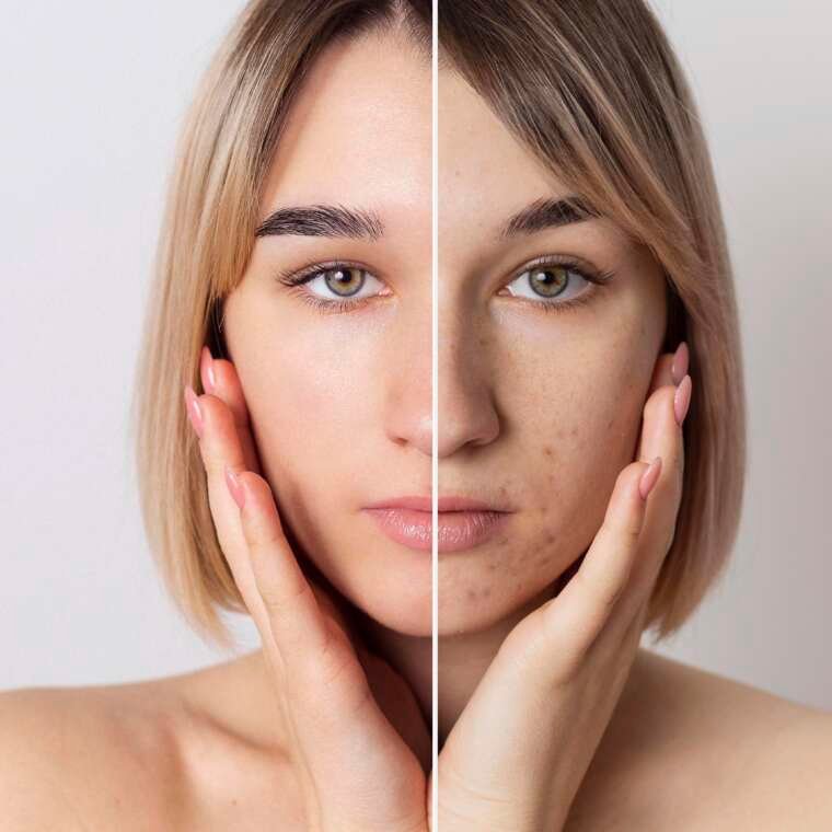 Ways to Treat Hyperpigmentation for a Smoother Skin